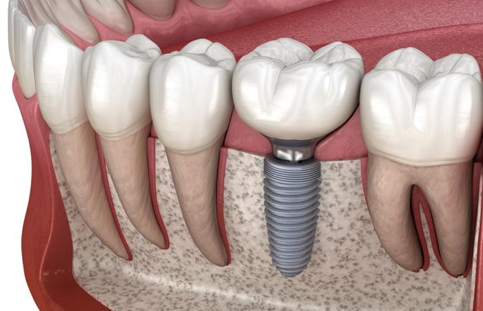 Имплантация зубов — современный и эффективный способ восстановления полноценности улыбки