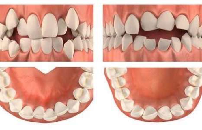Викривлення зубів: причини й небезпека такої патології