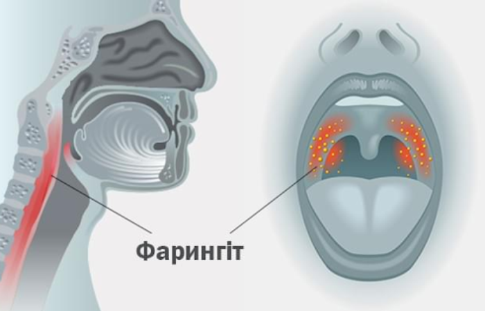Бактеріальний фарингіт: чому важливо не ігнорувати перші симптоми