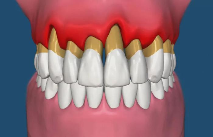 Какой план лечения пародонтита подходит при сильной кровоточивости десен и подвижности зубов?